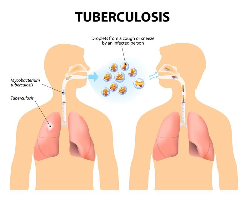 What Does Tuberculosis Do to the Body TB Symptoms Causes