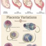 What Is a Placenta Types Development Complications