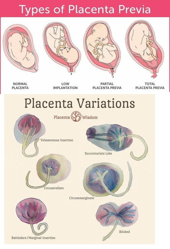 What Is a Placenta Types Development Complications