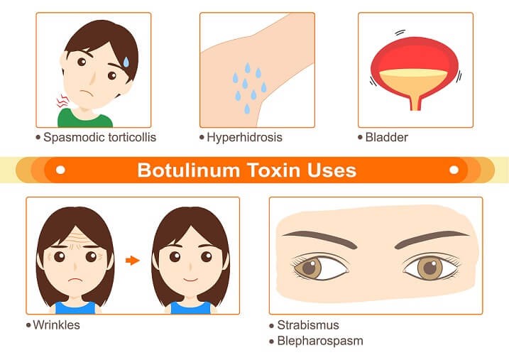 What Is Botulinum Toxin Used For