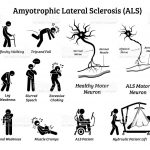 What Is the Life Expectancy of Lou Gehrig s Disease ALS