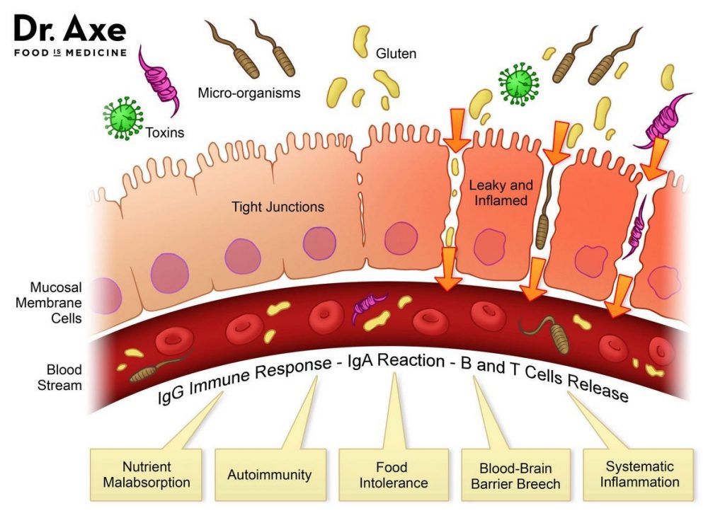 What Is the Main Cause of Leaky Gut and How Do You Fix It