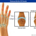 What to Do for Early Mild Osteoarthritis of the Hands