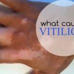 What Triggers Vitiligo