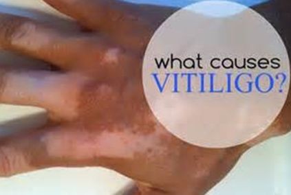 What Triggers Vitiligo