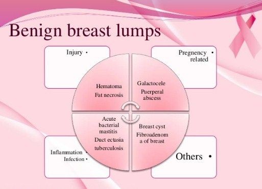 What Will Happen if Fibroadenoma Is Not Removed Symptoms Causes