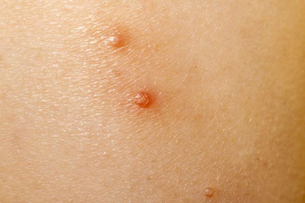 Ycanth Molloscum Contagiosum Uses Side Effects Dosage