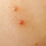 Ycanth Molloscum Contagiosum Uses Side Effects Dosage