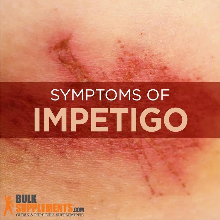 Impetigo Contagious Symptoms Causes Infection Treatment