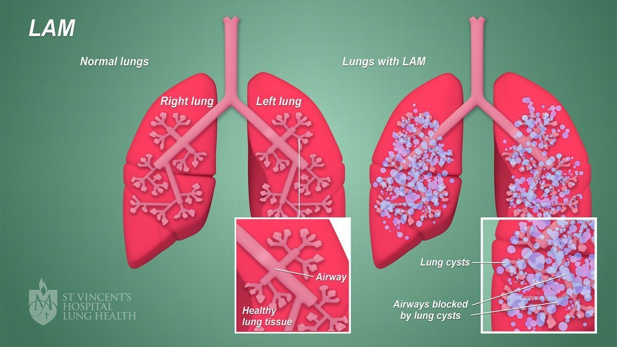Is LAM a Fatal Disease Life Expectancy Causes Symptoms