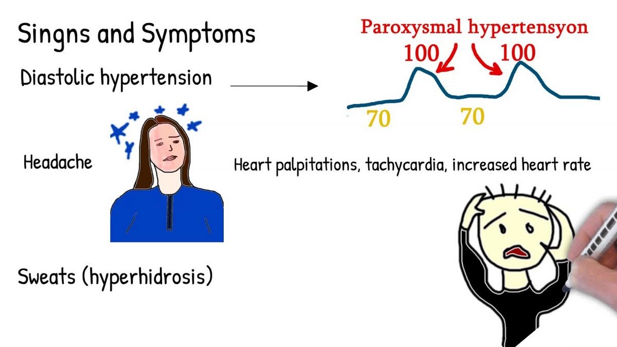 Pheochromocytoma Symptoms Treatment Diagnosis Prognosis