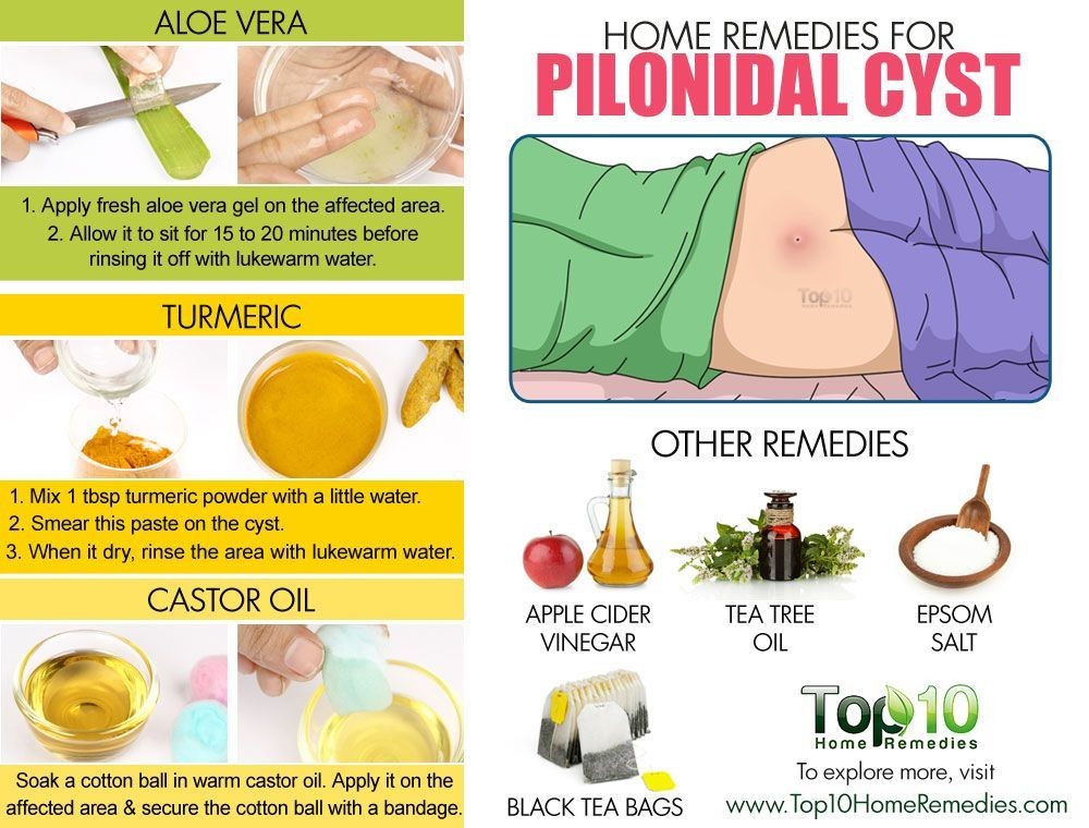 Pilonidal Cyst Pain Treatment Surgery Causes Symptoms