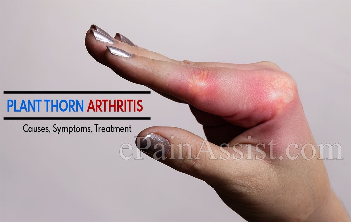 Plant Thorn Arthritis Infection Causes Symptoms Treatment