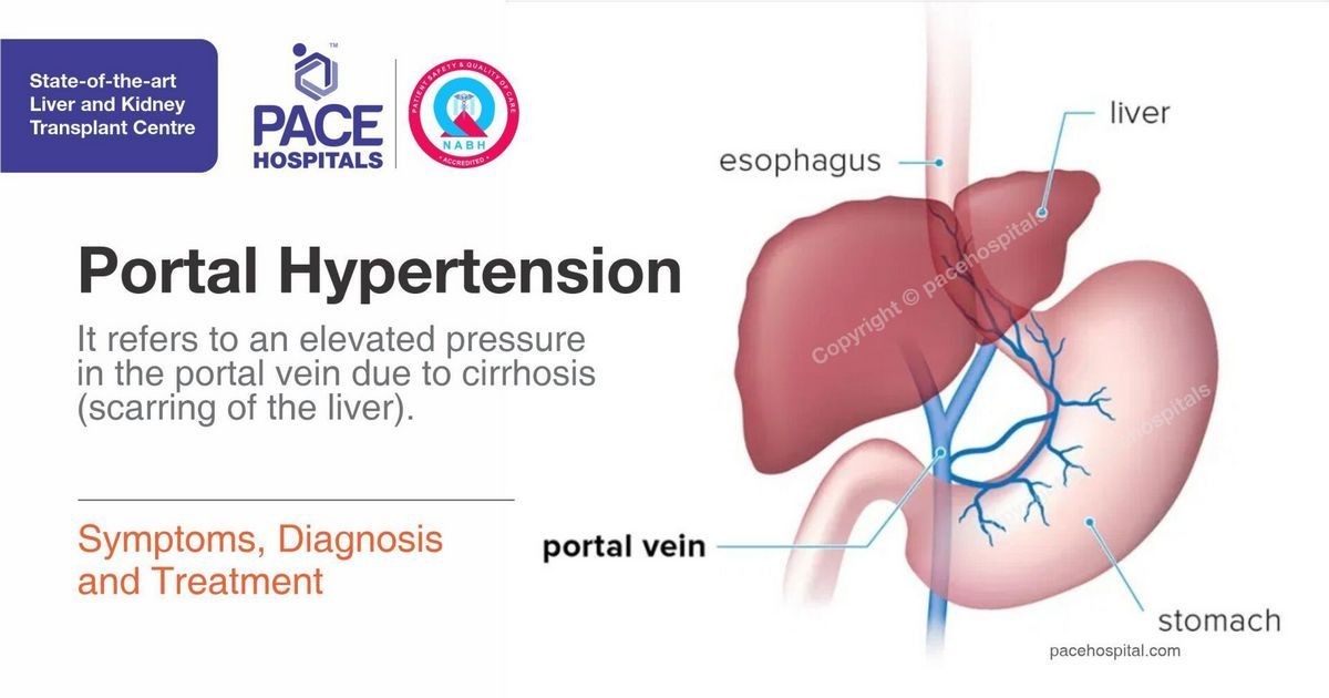 Portal Hypertension Causes Symptoms Treatment Prognosis