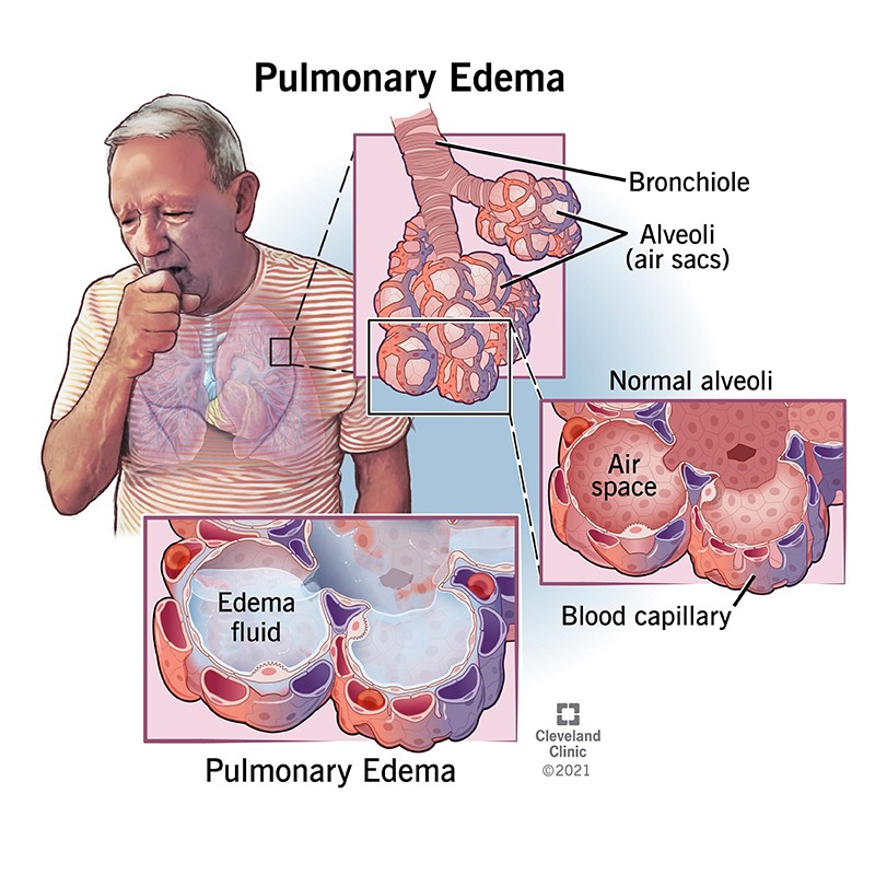 Pulmonary Edema Fluid in Lungs Causes Symptoms Treatment