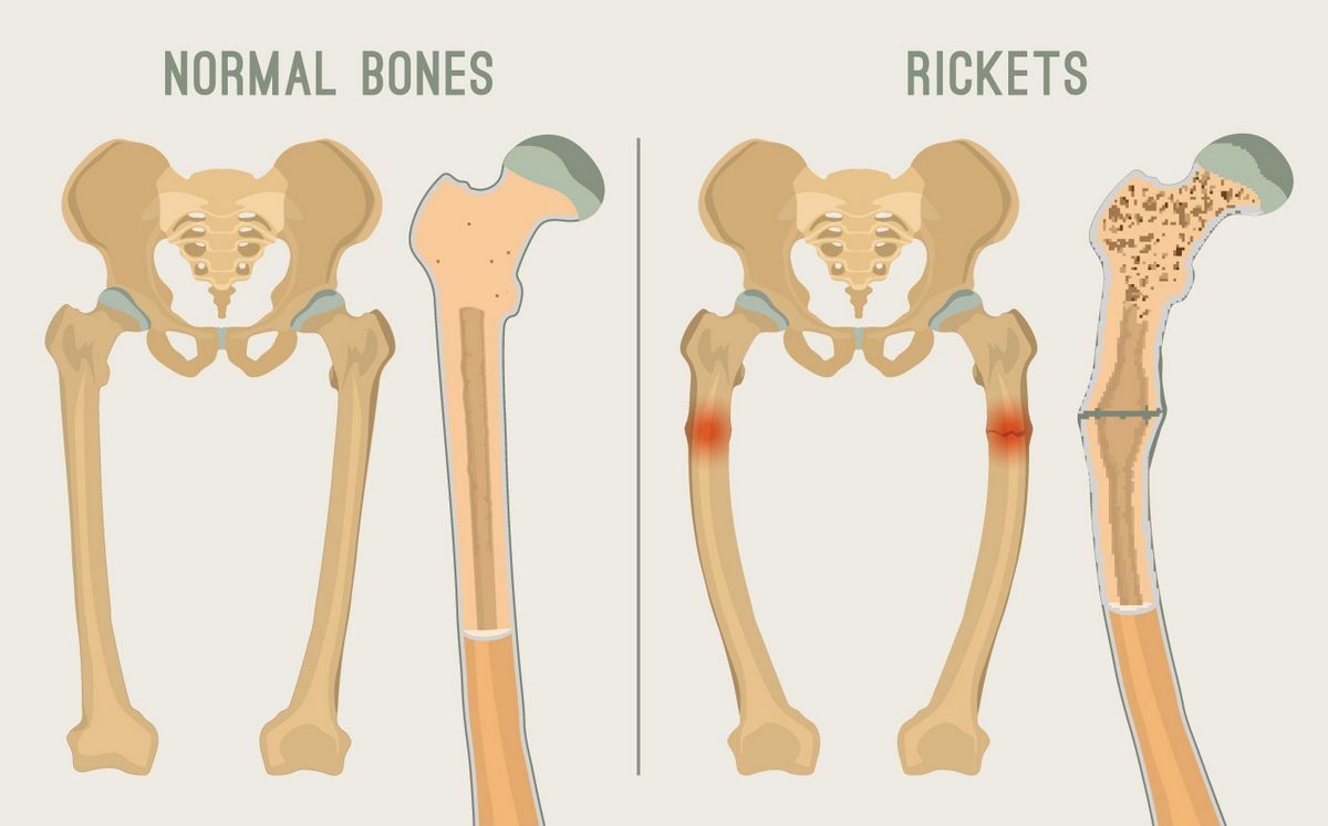 Rickets Definition Symptoms Treatment Causes