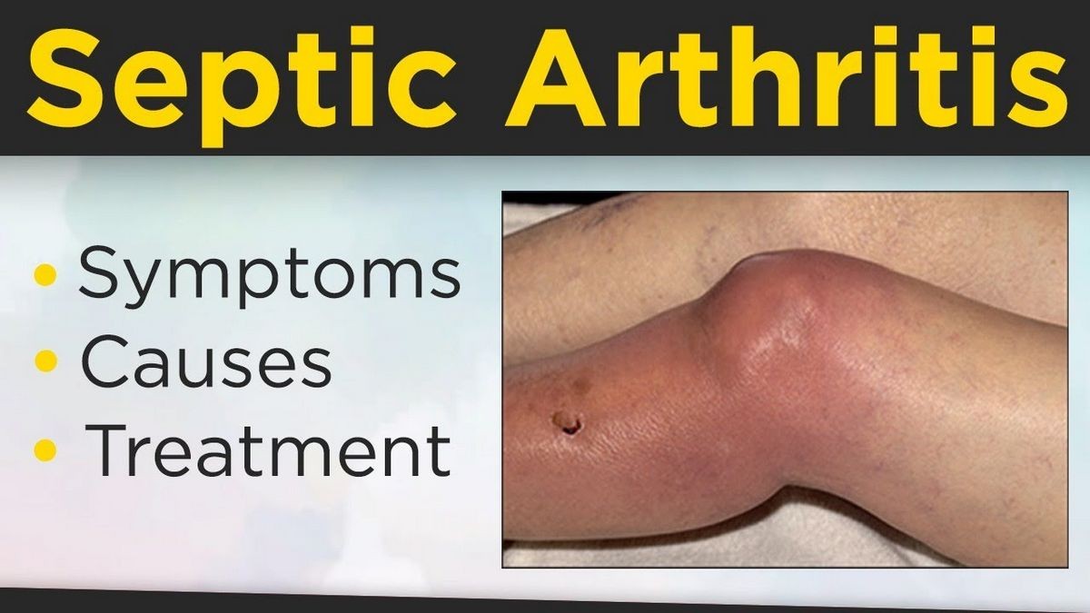 Septic Arthritis Causes Symptoms Treatment Medications Prevention