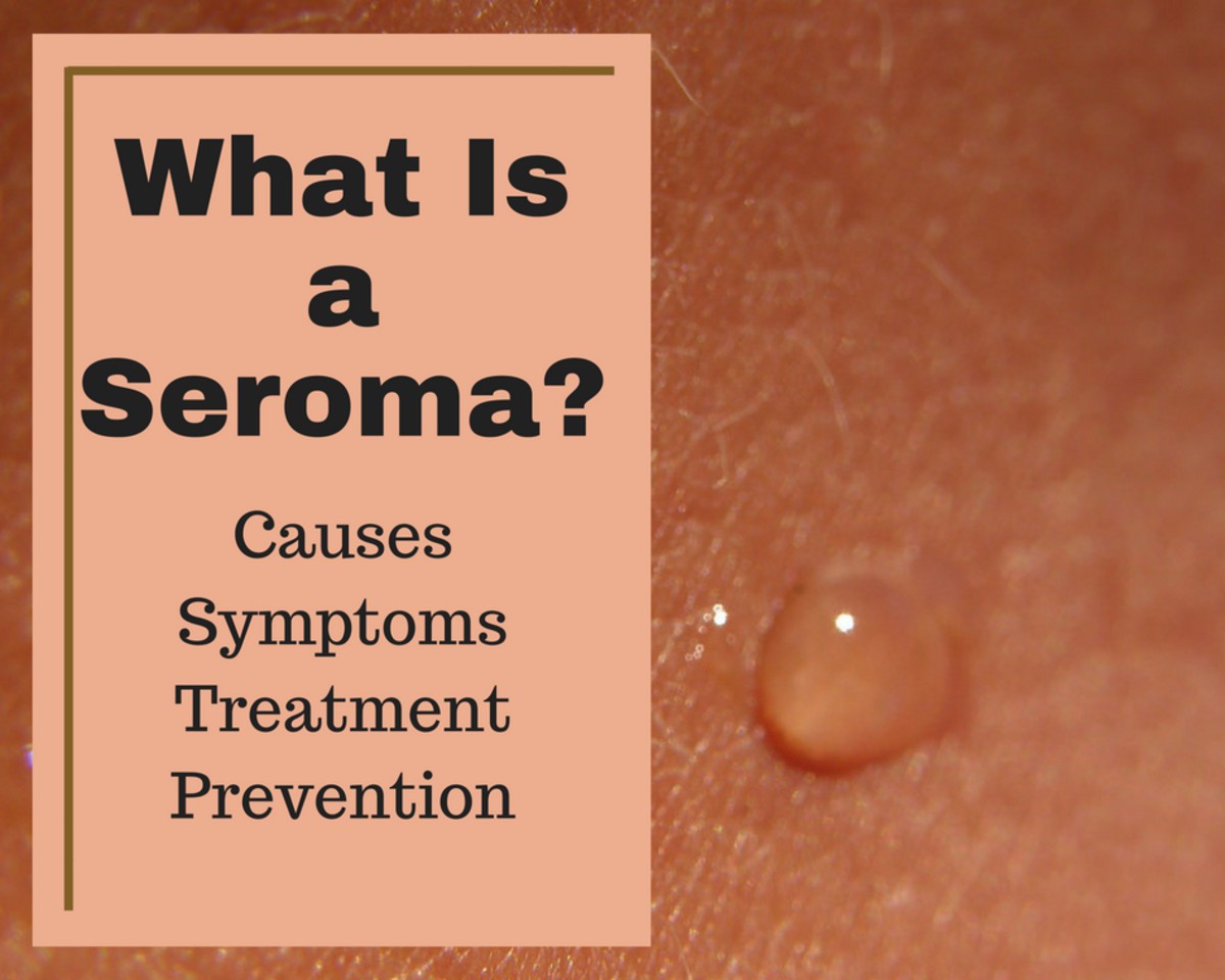Seroma Fluid Treatment Symptoms Causes Risks and More