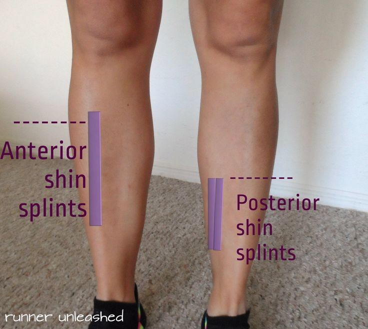 Shin Splints Causes Treatment Pain Relief Recovery Prevention