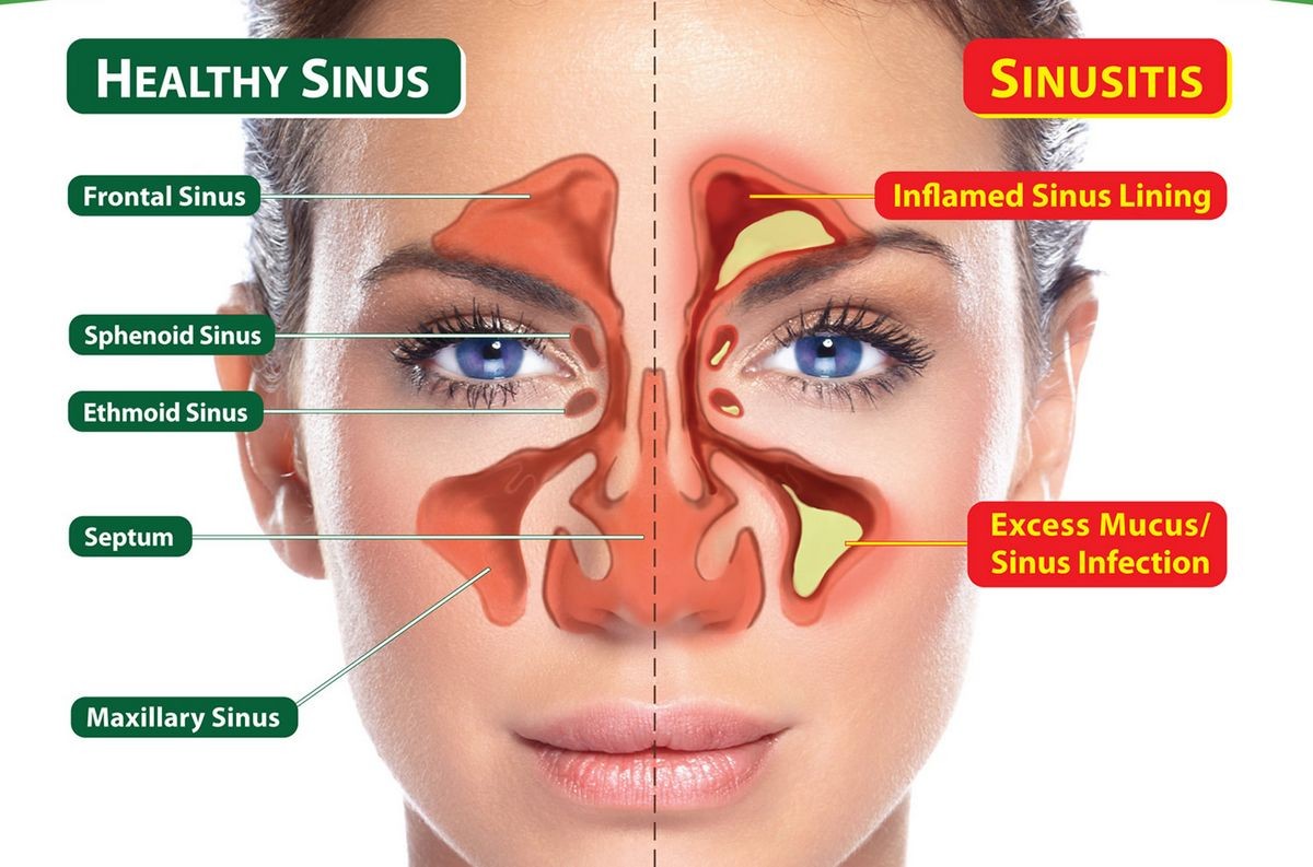 Sinus Headache Types Causes Symptoms Treatment Medicine