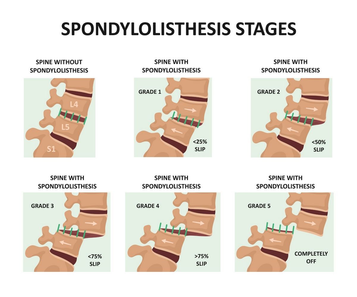 Spondylolisthesis Symptoms Treatment Surgery