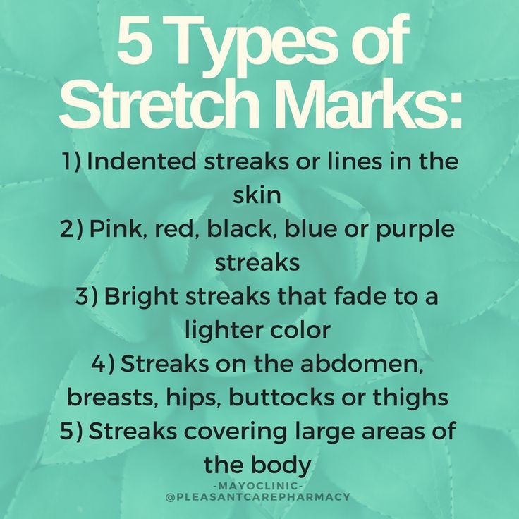 Stretch Marks Types Causes Risk Factors Symptoms Treatment