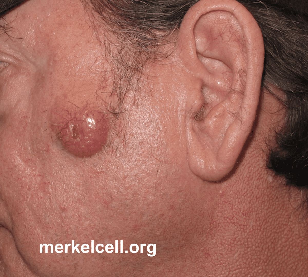 Survival Rate for Merkel Cell Carcinoma Stages of MCC