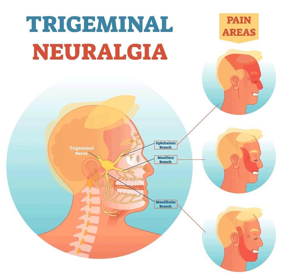 Trigeminal Neuralgia Treatment Causes Symptoms 12 Cranial Nerves