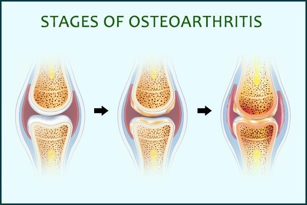 Types of Osteoarthritis Medications and Treatments