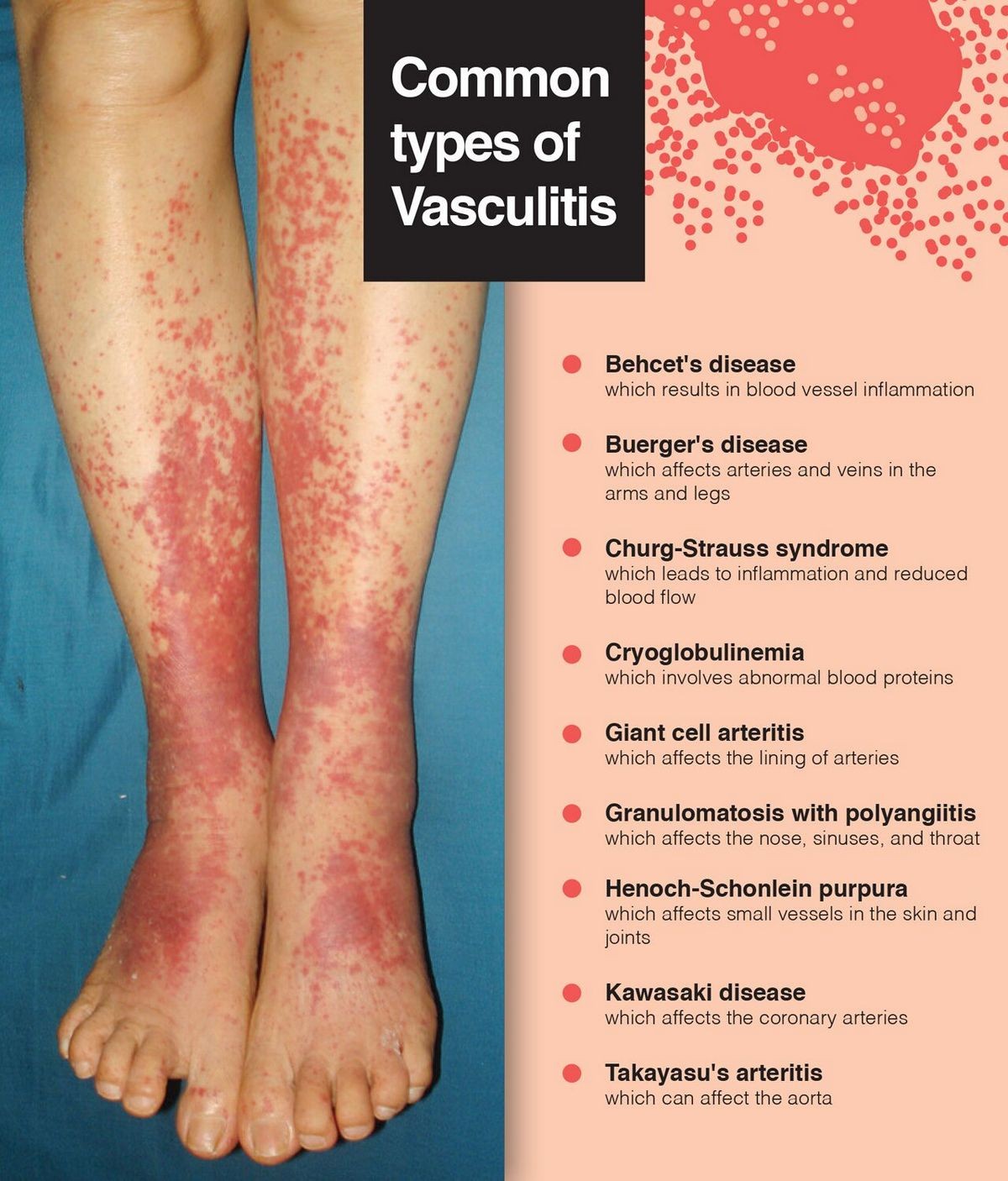 Vasculitis Types Causes Symptoms Diagnosis Treatment