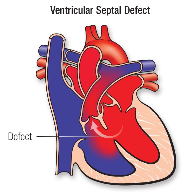 Ventricular Septal Defect VSD Types Symptoms Treatment