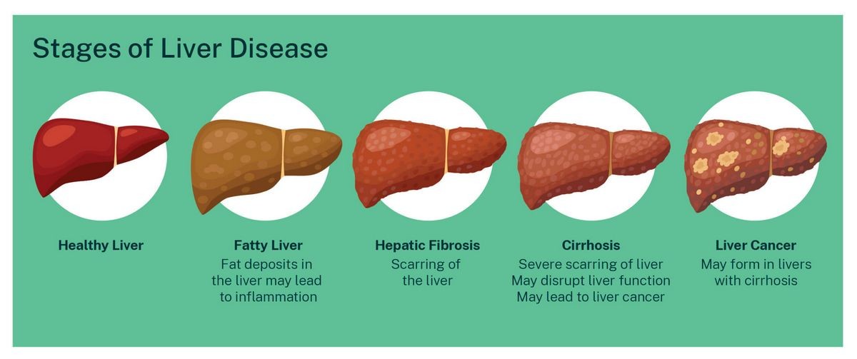 What Are the 4 Stages of Cirrhosis of the Liver