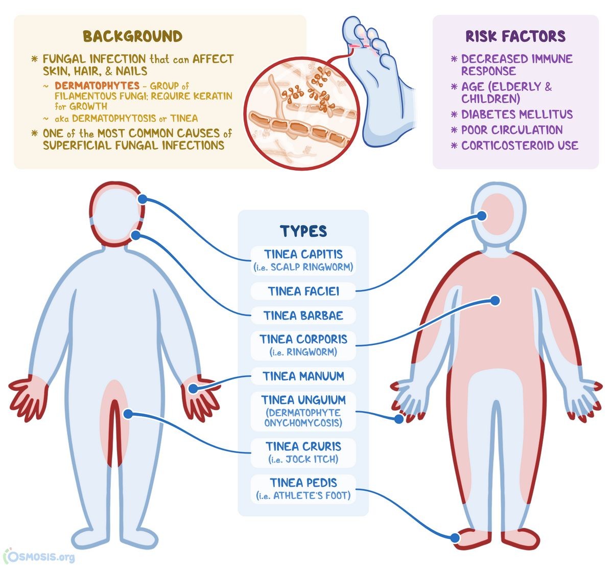 What Are the 4 Types of Fungal Infection Causes Symptoms Treatment