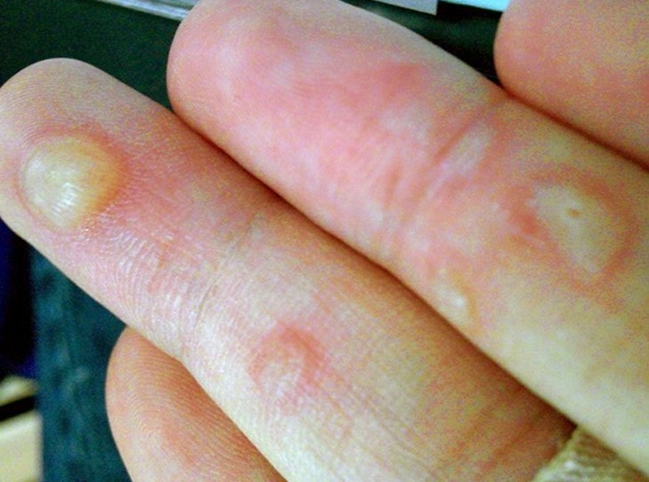 What Are the Causes of Blisters on the Hands