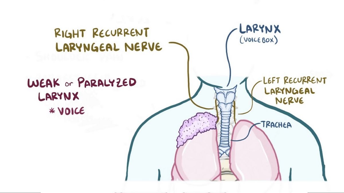 What Are the Symptoms of a Pancoast Tumor Cancer Stages