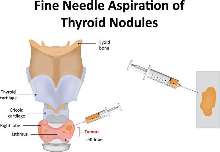 Thyroid Fine-Needle Aspiration Biopsy Side Effects Results