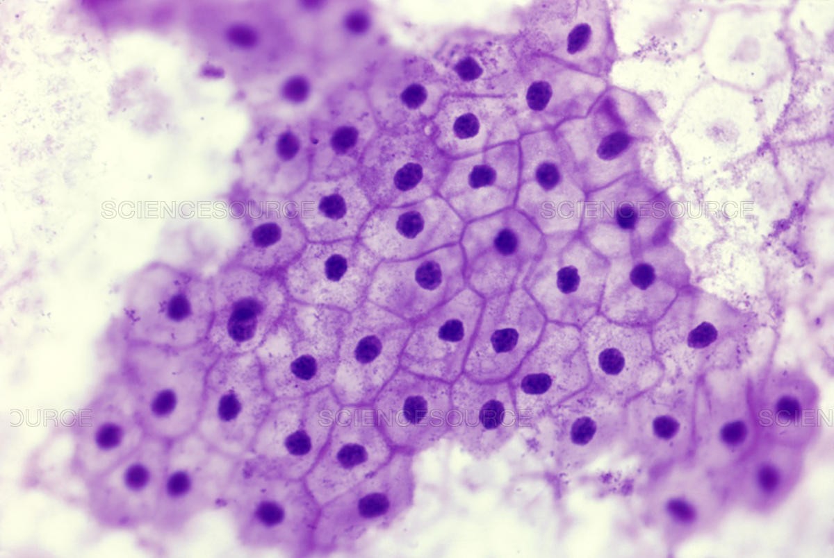 What Does It Mean to Have Squamous Epithelial Cells in Urine Normal High Ranges