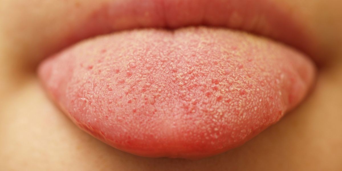 What Does It Mean When You Have Bumps on the Back of Your Tongue