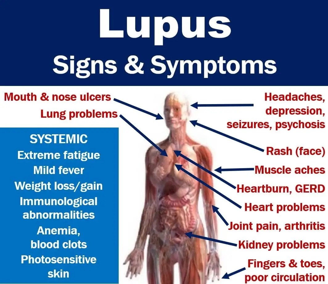 What Happens When You Have Lupus 12 Symptoms Types Causes