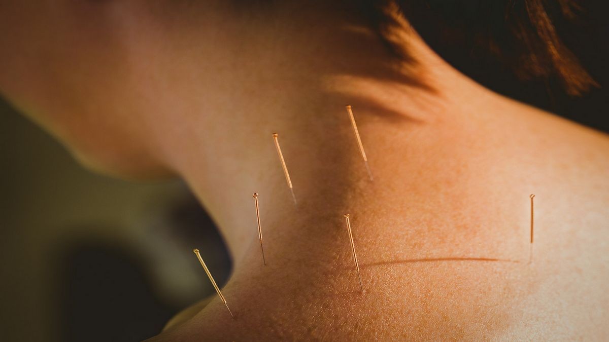 What Is Acupuncture Used For Benefits Points Needles