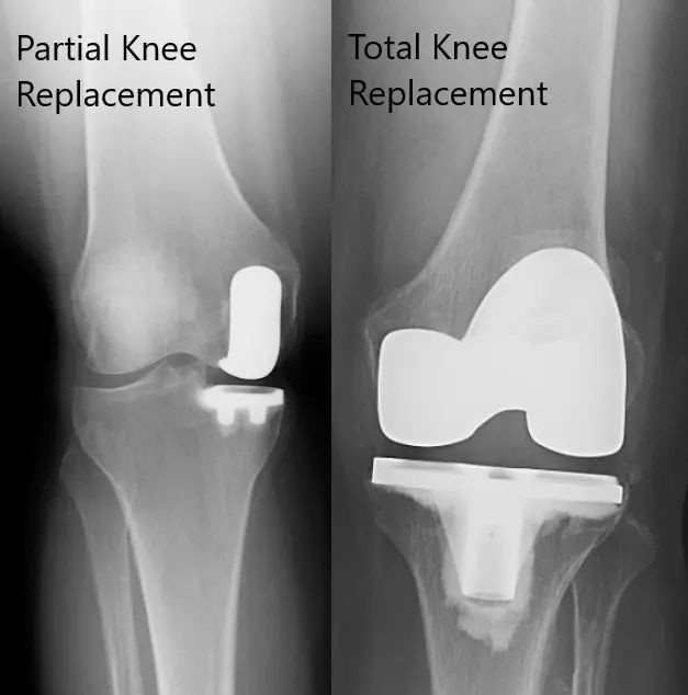 What Is the Best Age to Have Knee Replacement Total vs Partial