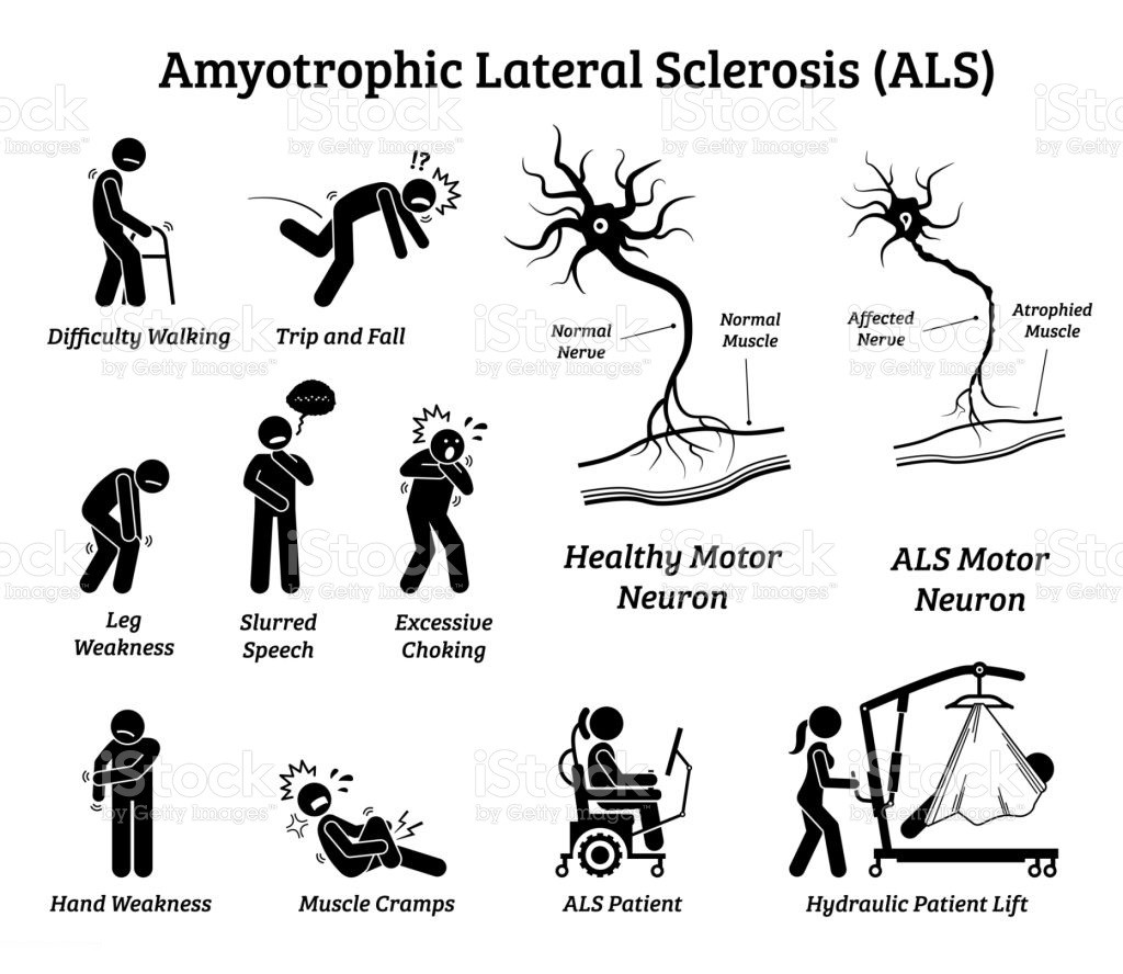 What Is the Life Expectancy of Lou Gehrig s Disease ALS