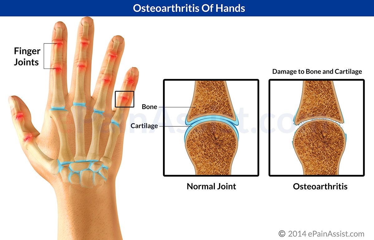 What to Do for Early Mild Osteoarthritis of the Hands