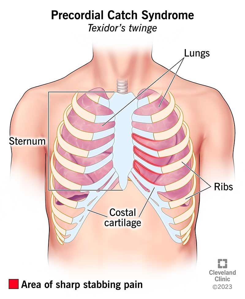 What Triggers Precordial Catch Syndrome Symptoms 7 Treatments