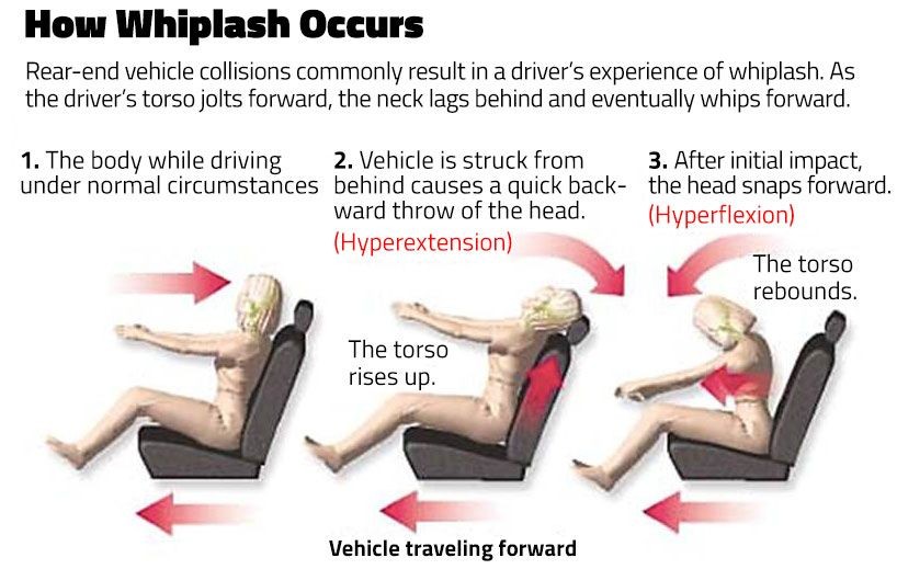 Whiplash Injury Symptoms Diagnosis Treatment