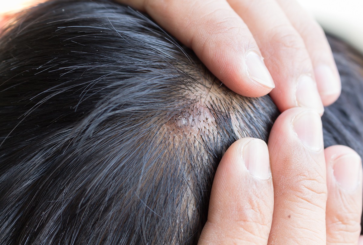 Why Do I Have Scabs on My Scalp 14 Causes Itchy Scalp 12 Home Remedies