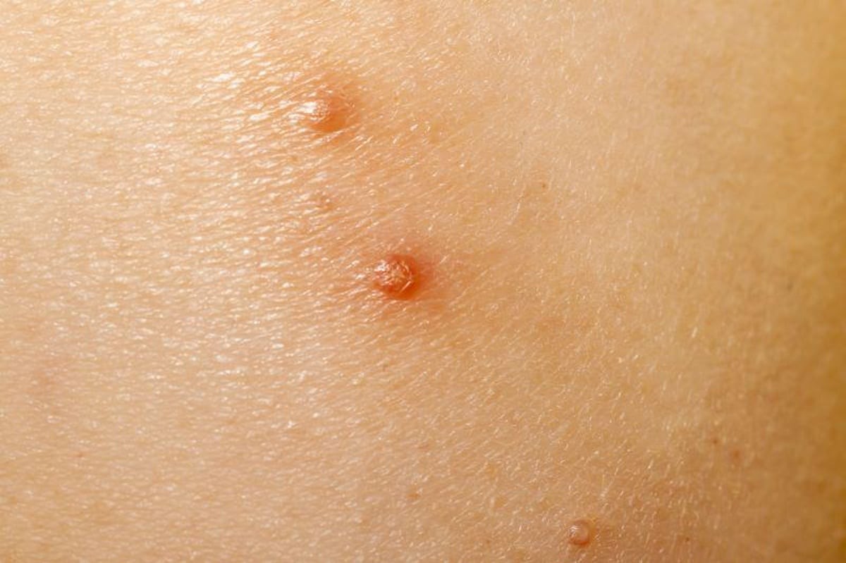 Ycanth Molloscum Contagiosum Uses Side Effects Dosage